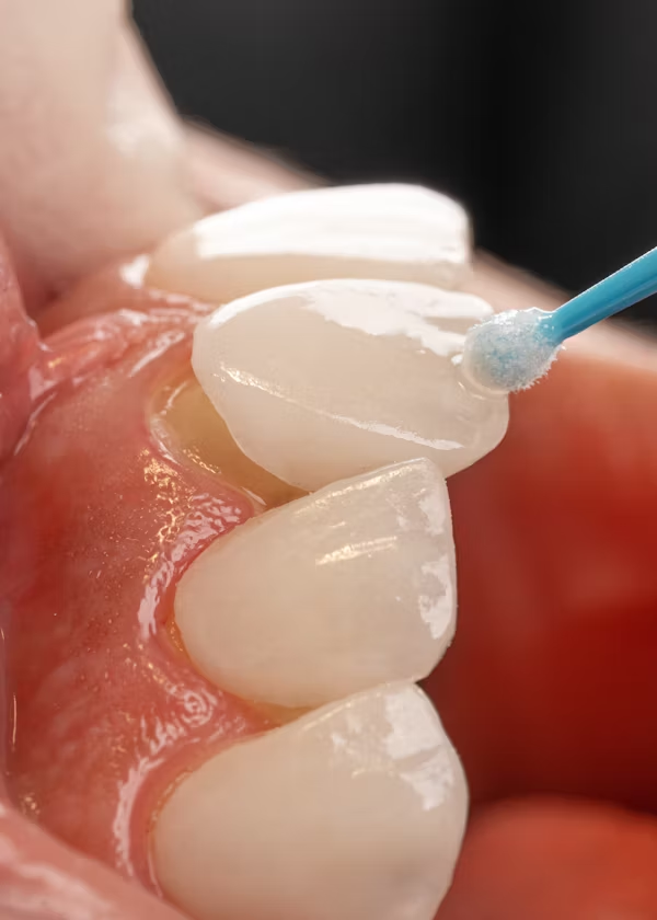image showing how veneers are applied to the tooth