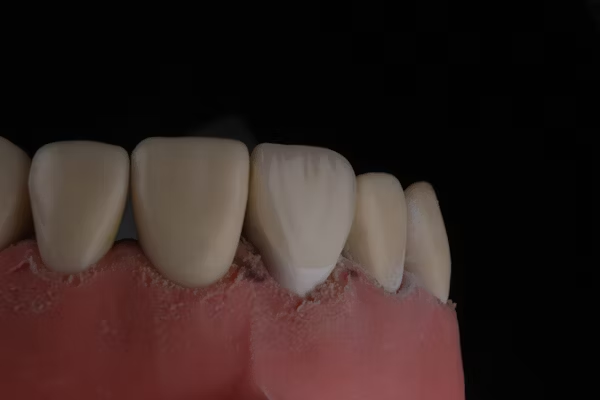 image of a dental model showing damaged gums