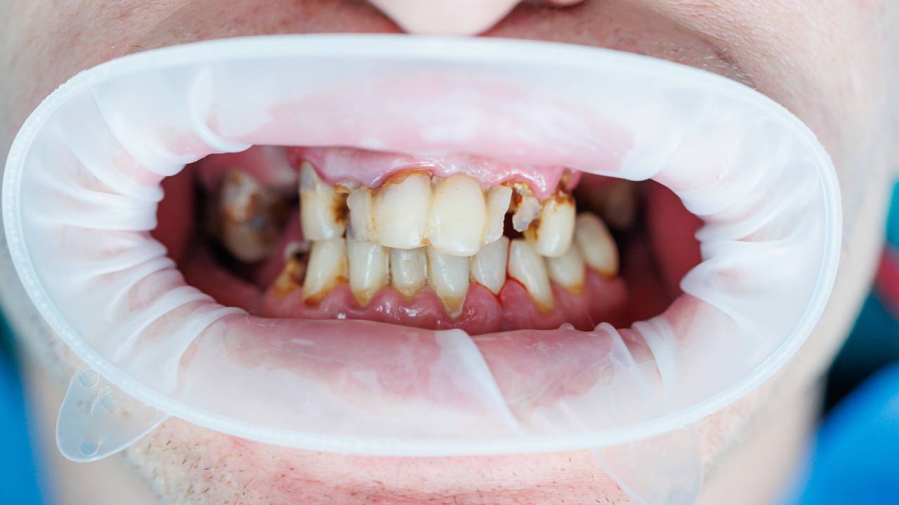 Can a Tooth Infection Spread? Why It’s Never Safe to Wait