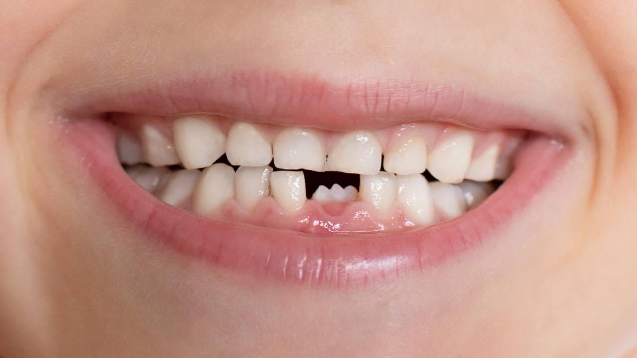 How Long Can You Leave a Missing Tooth Unreplaced?